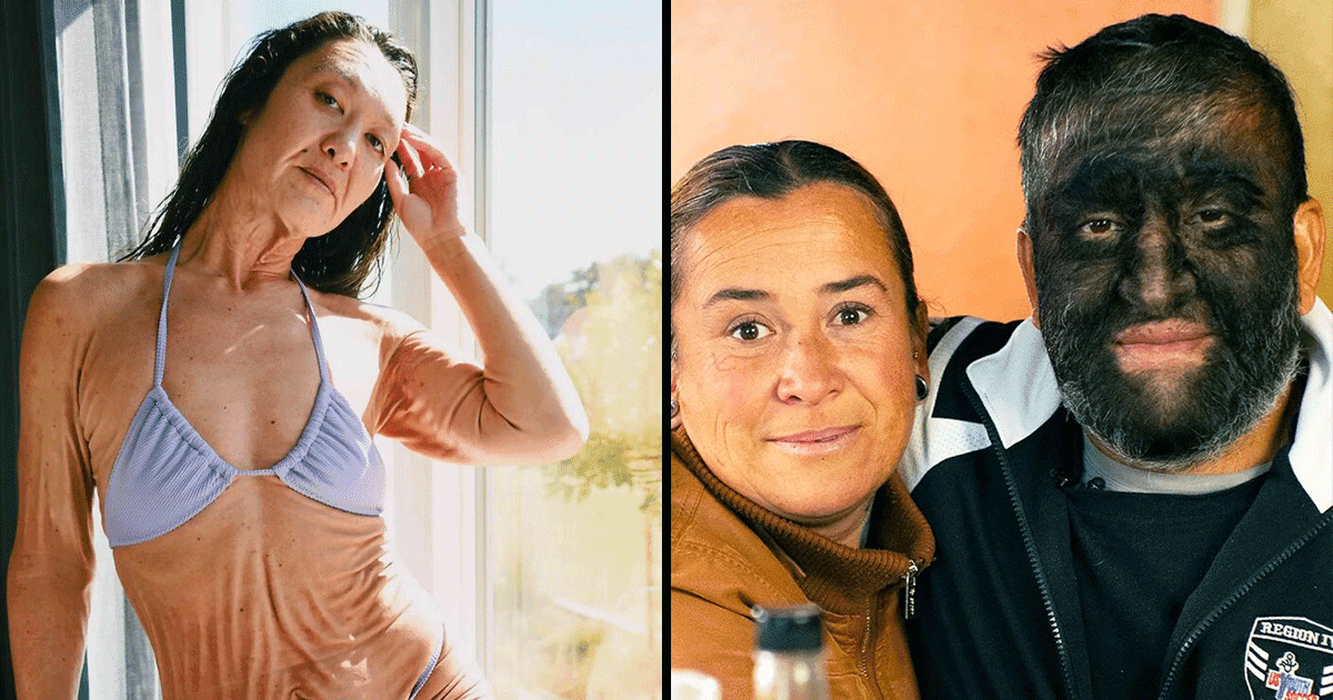 कुदरत की देन है इन 12 लोगों का अनोखा रंग-रूप, हैरतअंगेज़ है इनके शरीर की बनावट