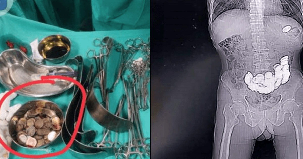 कर्नाटक: गुब्बारे जैसा हो गया था शख़्स का पेट, ऑपरेशन में निकले 462 रुपये के सिक्के