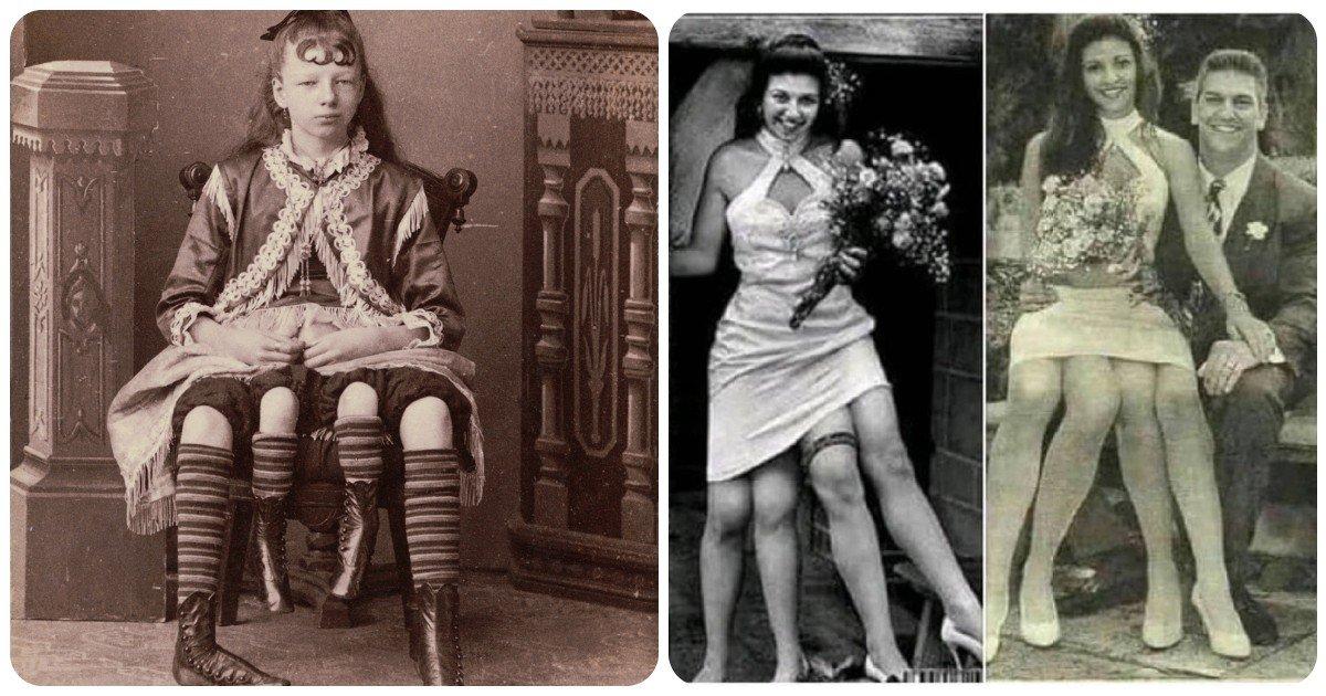 Myrtle Corbin: वो महिला जिसकी 2 नहीं, बल्कि 4 टांगे थीं, जिसके पैदा होने का रहस्य है बेहद रोचक
