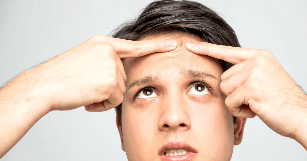 Pimples On Forehead: जानिए माथे पर मुंहासे क्यों होते हैं और इनसे बचने के आसान उपाय क्या हैं