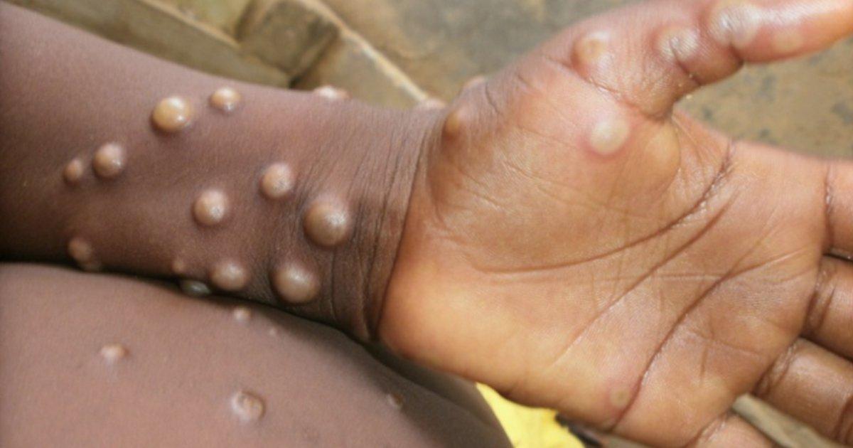 Monkeypox: जानिए इस दुर्लभ बीमारी का कारण, इसके लक्षण और इसके इलाज से जुड़ी ज़रूरी बातें